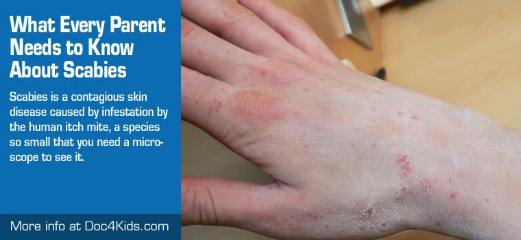 scabies rash on hands