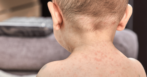 Pediatric Affiliates - Roseola